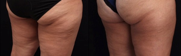 Cellulite Removal of Buttocks and Thighs