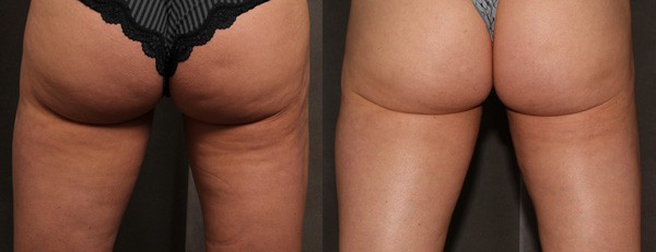 Cellulite Reduction Before and After Photos