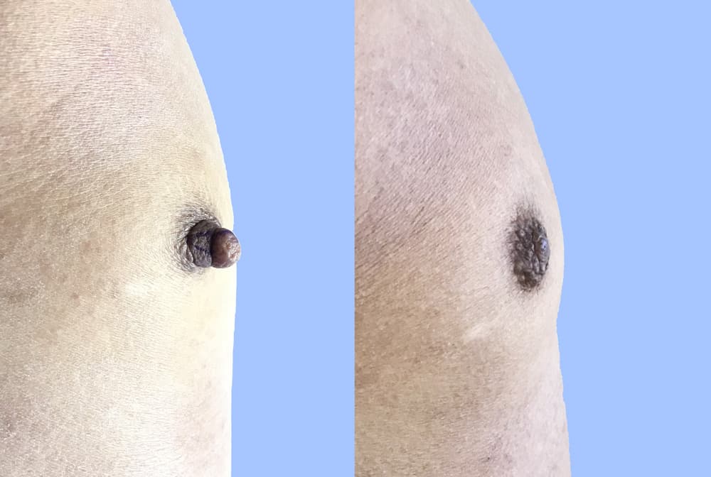 Male Nipple Correction Patient in Pasadena, CA